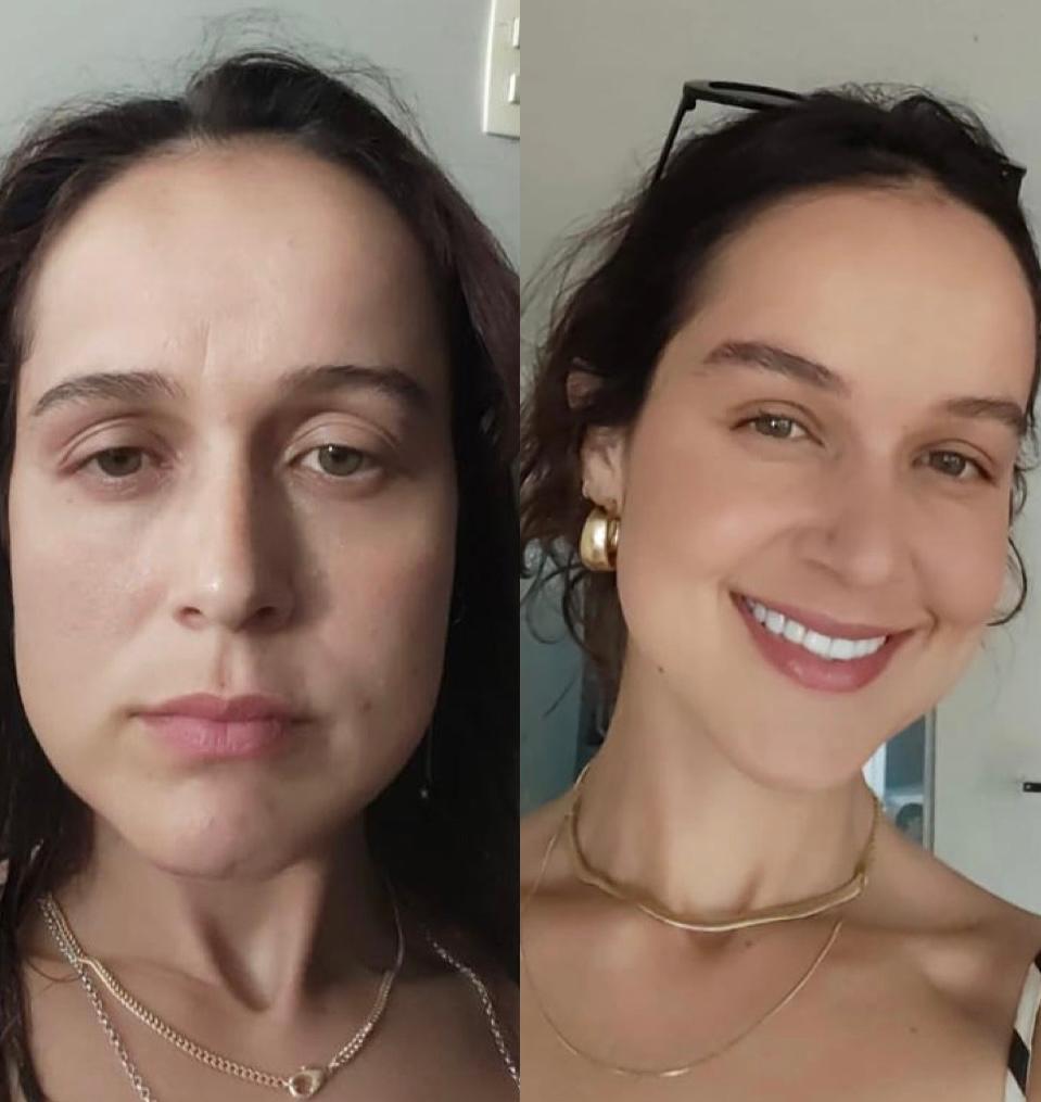 Blefaroplastia antes e depois em Dois Vizinhos – resultado pálpebra superior